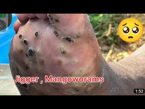 jigger removal man mangoworams removal in dog Animal rescue