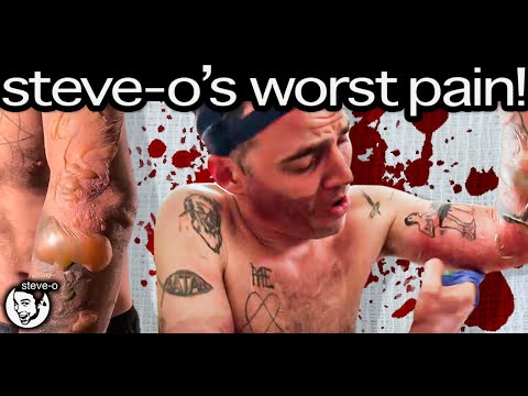 The Horrific Details Of My Most Painful Injury Ever | Steve-O