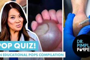 Dr Pimple Popper Pop Quiz! An Educational Pops Compilation