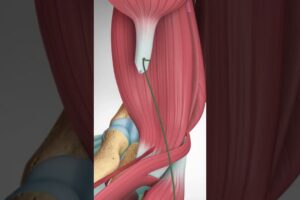 Distal Biceps Tendon Rupture and Repair  #bicepstendon #elbowpain #biceps