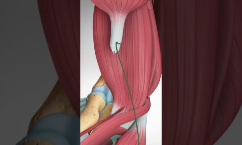 Distal Biceps Tendon Rupture and Repair  #bicepstendon #elbowpain #biceps